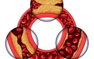 cholesterol