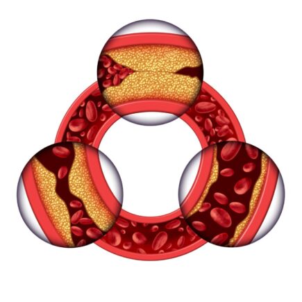 cholesterol