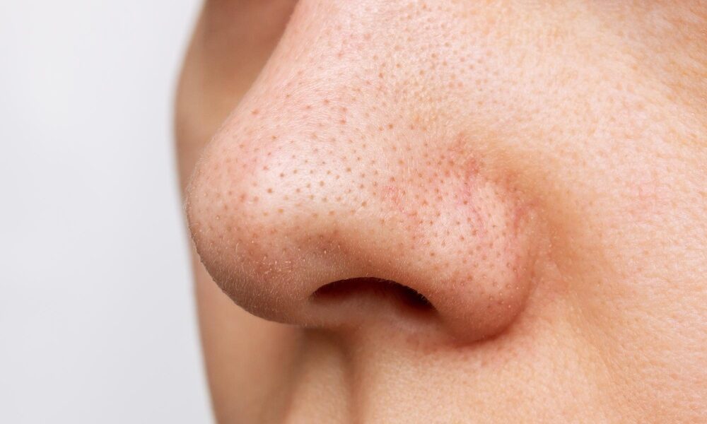 čierne bodky na nose