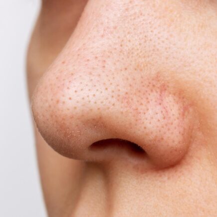 čierne bodky na nose